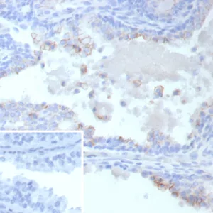 Formalin-fixed, paraffin-embedded human prostate cancer stained with ABCC4 Mouse Monoclonal Antibody (ABCC4/9019). Inset: PBS instead of primary antibody; secondary only negative control.