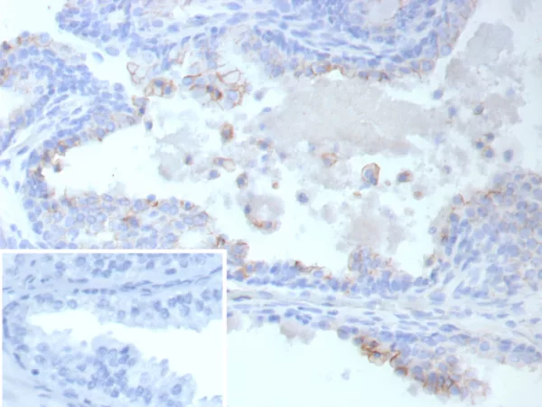 Formalin-fixed, paraffin-embedded human prostate cancer stained with ABCC4 Mouse Monoclonal Antibody (ABCC4/9019). Inset: PBS instead of primary antibody; secondary only negative control.