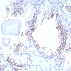 Formalin-fixed, paraffin-embedded human prostate cancer stained with ABCC4 Mouse Monoclonal Antibody (ABCC4/9179). HIER: Tris/EDTA, pH9.0, 45min. 2°C: HRP-polymer, 30min. DAB, 5min.