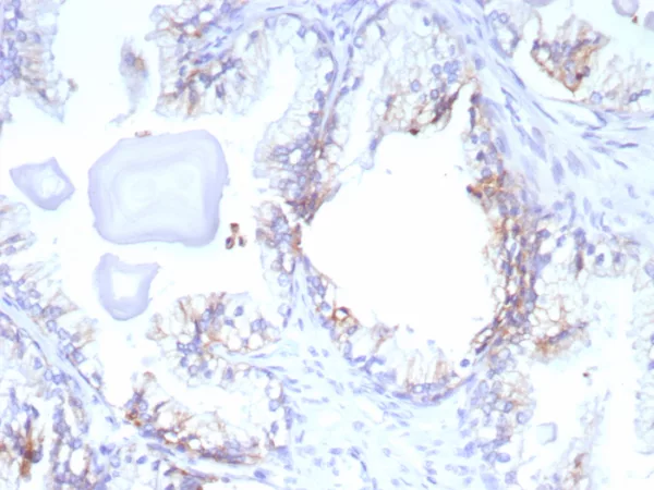 Formalin-fixed, paraffin-embedded human prostate cancer stained with ABCC4 Mouse Monoclonal Antibody (ABCC4/9179). HIER: Tris/EDTA, pH9.0, 45min. 2°C: HRP-polymer, 30min. DAB, 5min.