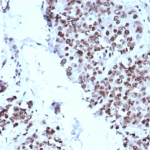 IHC analysis of formalin-fixed, paraffin-embedded human bladder.  Strong nuclear staining using KIP2/8572 at 2ug/ml in PBS for 30min RT.