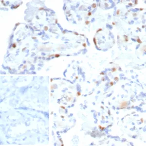 IHC analysis of formalin-fixed, paraffin-embedded human bladder.  Strong nuclear staining using rKIP2/7238 at 2ug/ml in PBS for 30min RT. Inset: PBS instead of primary antibody; secondary only negative control.