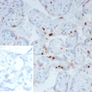 IHC analysis of formalin-fixed, paraffin-embedded human placenta.  Strong nuclear staining using KIP2/8169R at 2ug/ml in PBS for 30min RT. Inset: PBS instead of primary antibody; secondary only negative control.