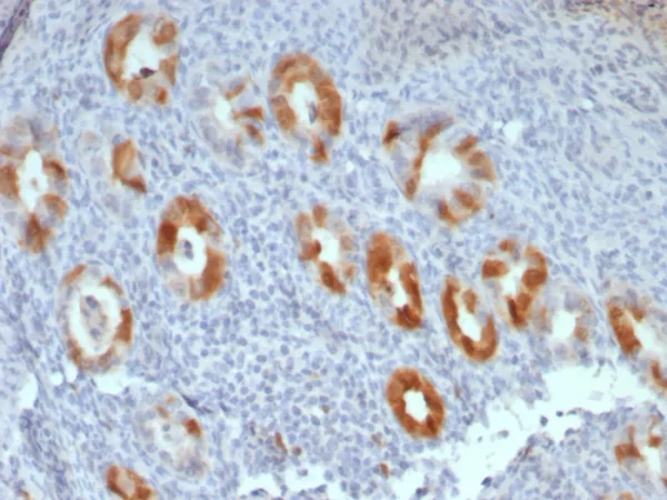 Formalin-fixed, paraffin-embedded human cervical carcinoma stained with P16INK4a Recombinant Mouse Monoclonal Antibody (rCDKN2A/8061). HIER: Tris/EDTA, pH9.0, 45min. 2°C: HRP-polymer, 30min. DAB, 5min.