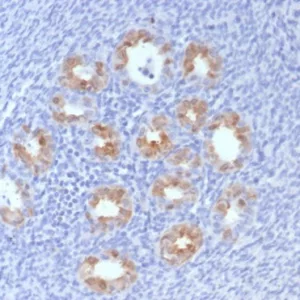 Formalin-fixed, paraffin-embedded human cervix stained with P16INK4a Recombinant Mouse Monoclonal Antibody (rCDKN2A/8004). HIER: Tris/EDTA, pH9.0, 45min. 2°C: HRP-polymer, 30min. DAB, 5min.