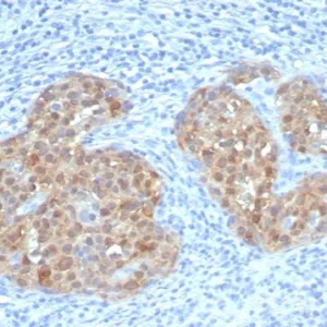 Formalin-fixed, paraffin-embedded human cervical carcinoma stained with P16INK4a Recombinant Mouse Monoclonal Antibody (rCDKN2A/7659). HIER: Tris/EDTA, pH9.0, 45min. 2°C: HRP-polymer, 30min. DAB, 5min.