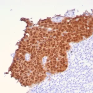 Formalin-fixed, paraffin-embedded human cervical carcinoma stained with P16INK4a Recombinant Rabbit Monoclonal Antibody (CDKN2A/8196R). HIER: Tris/EDTA, pH9.0, 45min. 2: HRP-polymer, 30min. DAB, 5min.