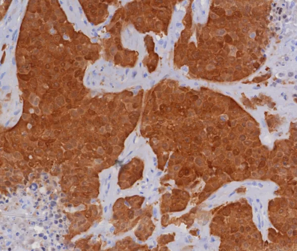 ormalin-fixed, paraffin-embedded human bladder carcinoma stained with P16INK4a Recombinant Rabbit Monoclonal Antibody (CDKN2A/8196R). HIER: Tris/EDTA, pH9.0, 45min. 2: HRP-polymer, 30min. DAB, 5min.