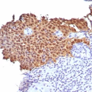 Formalin-fixed, paraffin-embedded human cervical carcinoma stained with P16INK4a Recombinant Rabbit Monoclonal Antibody (CDKN2A/8223R). HIER: Tris/EDTA, pH9.0, 45min. 2°C: HRP-polymer, 30min. DAB, 5min.