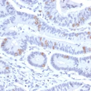 Formalin-fixed, paraffin-embedded human colon stained with BRAF35 Mouse Monoclonal Antibody (PCRP-HMG20B-1B5). HIER: Tris/EDTA, pH9.0, 45min. 2°C: HRP-polymer, 30min. DAB, 5min.