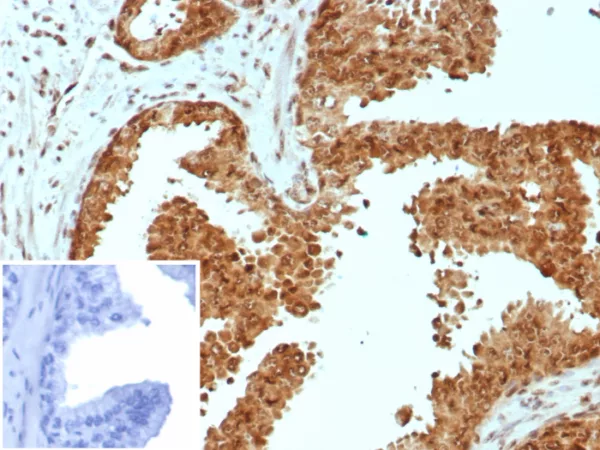 Formalin-fixed, paraffin-embedded human prostate carcinoma stained with CARM1 Mouse Monoclonal Antibody (CARM1/7426). Inset: PBS instead of primary antibody; secondary only negative control.
