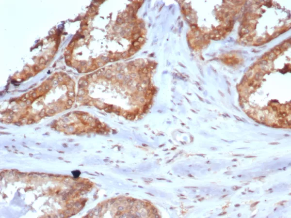 Formalin-fixed, paraffin-embedded human prostate stained with CARM1 Mouse Monoclonal Antibody (CARM1/7426). HIER: Tris/EDTA, pH9.0, 45min. 2°C: HRP-polymer, 30min. DAB, 5min.