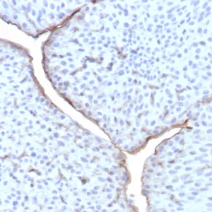 Formalin-fixed, paraffin-embedded human bladder stained with Uroplakin 3B Recombinant Rabbit Monoclonal Antibody (UPK3B/8550R). HIER: Tris/EDTA, pH9.0, 45min. 2°C: HRP-polymer, 30min. DAB, 5min.