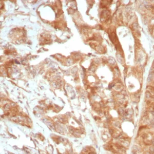 Formalin-fixed, paraffin-embedded human prostate stained with Podoplanin Recombinant Rabbit Monoclonal Antibody (PDPN/8875R). HIER: Tris/EDTA, pH9.0, 45min. 2°C: HRP-polymer, 30min. DAB, 5min.