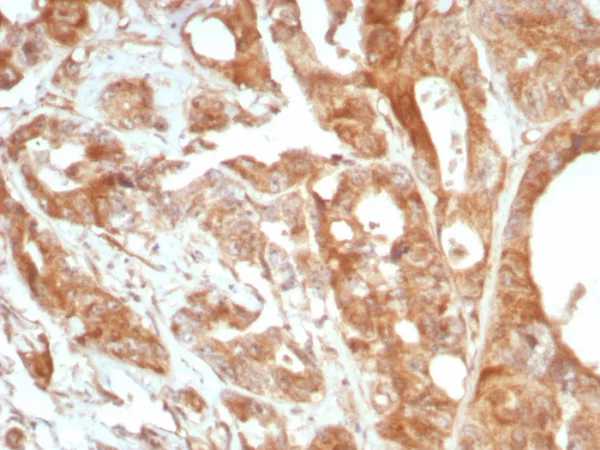 Formalin-fixed, paraffin-embedded human prostate stained with Podoplanin Recombinant Rabbit Monoclonal Antibody (PDPN/8875R). HIER: Tris/EDTA, pH9.0, 45min. 2°C: HRP-polymer, 30min. DAB, 5min.