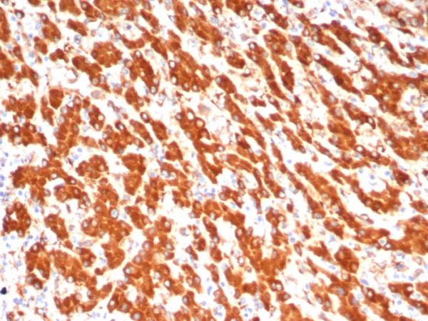 Formalin-fixed, paraffin-embedded human hepatocellular carcinoma stained with ADH1L1 Mouse Monoclonal Antibody (ALDH1L1/7702). HIER: Tris/EDTA, pH9.0, 45min. 2°C: HRP-polymer, 30min. DAB, 5min.