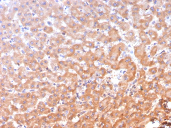 Formalin-fixed, paraffin-embedded human hepatocellular carcinoma stained with ADH1L1 Mouse Monoclonal Antibody (ALDH1L1/7958). HIER: Tris/EDTA, pH9.0, 45min. 2°C: HRP-polymer, 30min. DAB, 5min.
