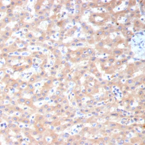Formalin-fixed, paraffin-embedded human hepatocellular carcinoma stained with ADH1L1 Mouse Monoclonal Antibody (ALDH1L1/7959). HIER: Tris/EDTA, pH9.0, 45min. 2°C: HRP-polymer, 30min. DAB, 5min.