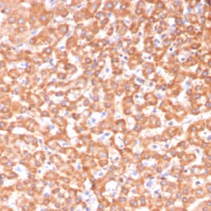 Formalin-fixed, paraffin-embedded human hepatocellular carcinoma stained with ADH1L1 Mouse Monoclonal Antibody (ALDH1L1/7969). HIER: Tris/EDTA, pH9.0, 45min. 2°C: HRP-polymer, 30min. DAB, 5min.