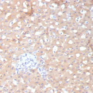 Formalin-fixed, paraffin-embedded human hepatocellular carcinoma stained with ADH1L1 Mouse Monoclonal Antibody (ALDH1L1/7970). HIER: Tris/EDTA, pH9.0, 45min. 2°C: HRP-polymer, 30min. DAB, 5min.