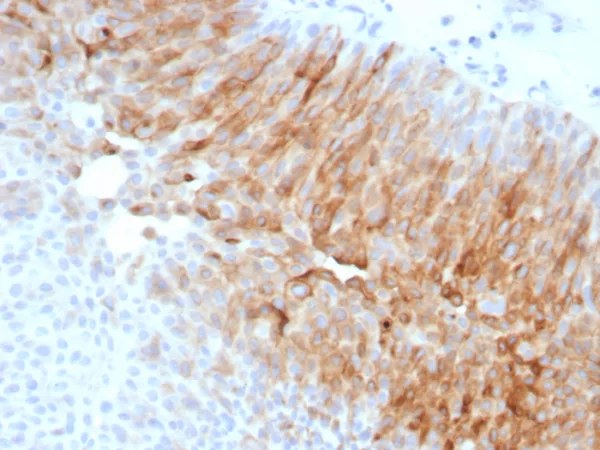 Formalin-fixed, paraffin-embedded human bladder carcinoma stained with Uroplakin 1A Recombinant Rabbit Monoclonal Antibody (UPK1A/8704R). HIER: Tris/EDTA, pH9.0, 45min. 2: HRP-polymer, 30min. DAB, 5min.