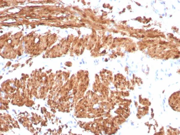 Formalin-fixed, paraffin-embedded human smooth muscle stained with Calponin Rabbit Recombinant Monoclonal Antibody (CNN1/8870R). HIER: Tris/EDTA, pH9.0, 45min. 2°C: HRP-polymer, 30min. DAB, 5min.