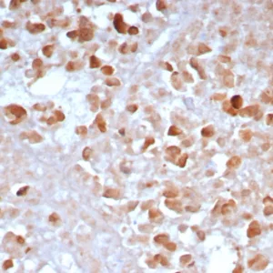 Formalin-fixed, paraffin-embedded human pancreas stained with CPA1 Recombinant Rabbit Monoclonal Antibody (CPA1/8163R). HIER: Tris/EDTA, pH9.0, 45min. 2°C: HRP-polymer, 30min. DAB, 5min.