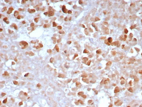 Formalin-fixed, paraffin-embedded human pancreas stained with CPA1 Recombinant Rabbit Monoclonal Antibody (CPA1/8163R). HIER: Tris/EDTA, pH9.0, 45min. 2°C: HRP-polymer, 30min. DAB, 5min.