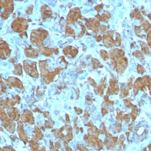 Formalin-fixed, paraffin-embedded human pancreas stained with CPA1 Recombinant Rabbit Monoclonal Antibody (CPA1/8259R). HIER: Tris/EDTA, pH9.0, 45min. 2°C: HRP-polymer, 30min. DAB, 5min.
