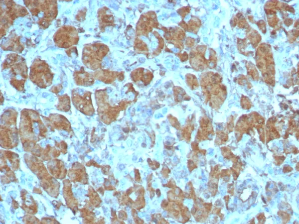 Formalin-fixed, paraffin-embedded human pancreas stained with CPA1 Recombinant Rabbit Monoclonal Antibody (CPA1/8259R). HIER: Tris/EDTA, pH9.0, 45min. 2°C: HRP-polymer, 30min. DAB, 5min.
