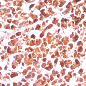 Formalin-fixed, paraffin-embedded human pancreas stained with CPA1 Recombinant Rabbit Monoclonal Antibody (CPA1/8289R). HIER: Tris/EDTA, pH9.0, 45min. 2°C: HRP-polymer, 30min. DAB, 5min.