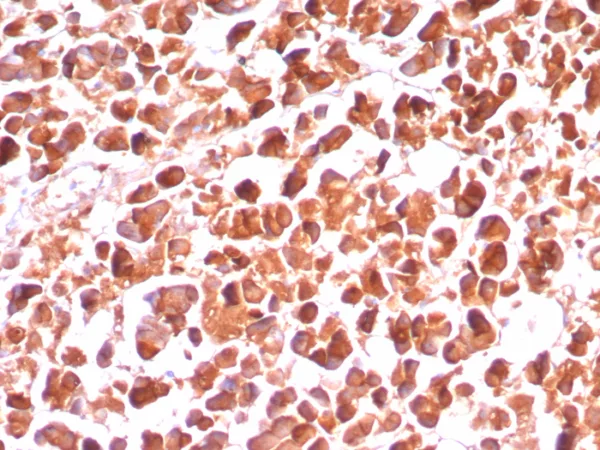 Formalin-fixed, paraffin-embedded human pancreas stained with CPA1 Recombinant Rabbit Monoclonal Antibody (CPA1/8289R). HIER: Tris/EDTA, pH9.0, 45min. 2°C: HRP-polymer, 30min. DAB, 5min.