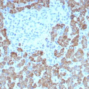 Formalin-fixed, paraffin-embedded human hepatocellular carcinoma stained with CPS1 Mouse Monoclonal Antibody (CPS1/8417). HIER: Tris/EDTA, pH9.0, 45min. 2°C: HRP-polymer, 30min. DAB, 5min.
