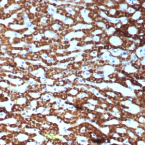 Formalin-fixed, paraffin-embedded human hepatocellular carcinoma stained with CPS1 Recombinant Rabbit Monoclonal Antibody (CPS1/9151R). HIER: Tris/EDTA, pH9.0, 45min. 2°C: HRP-polymer, 30min. DAB, 5min.