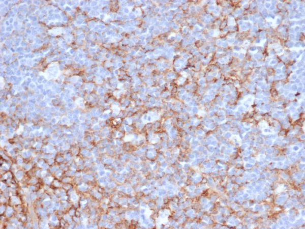 Formalin-fixed, paraffin-embedded Human Tonsil stained with CD21 Mouse Monoclonal Antibody (CR2/6683). HIER: Tris/EDTA, pH9.0, 45min. 2°C: HRP-polymer, 30min. DAB, 5min.