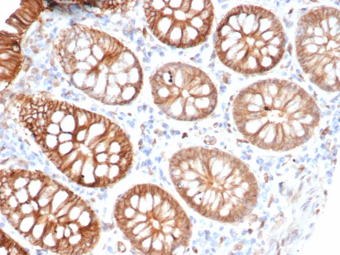 Formalin-fixed, paraffin-embedded human colon carcinoma stained with S100A16 Mouse Monoclonal Antibody (S100A16/7411). HIER: Tris/EDTA, pH9.0, 45min. 2°C: HRP-polymer, 30min. DAB, 5min. S100A16 (S100 calcium binding protein A16) Antibody - Image 3