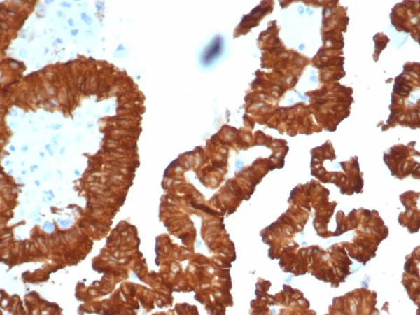 Formalin-fixed, paraffin-embedded human kidney cancer stained with Crystallin Alpha B Mouse Monoclonal Antibody (CRYAB/4661). HIER: Tris/EDTA, pH9.0, 45min. 2°C: HRP-polymer, 30min. DAB, 5min.