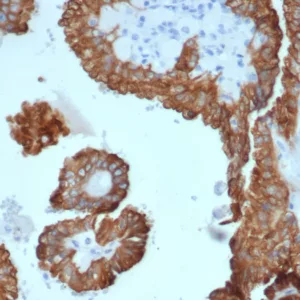 Formalin-fixed, paraffin-embedded human kidney carcinoma stained with Crystallin Alpha B Mouse Monoclonal Antibody (CRYAB/4662). HIER: Tris/EDTA, pH9.0, 45min. 2°C: HRP-polymer, 30min. DAB, 5min.