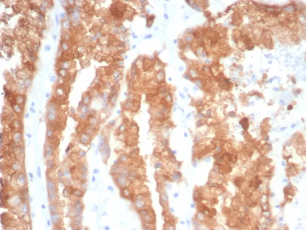 Formalin-fixed, paraffin-embedded human prostate cancer stained with Crystallin Alpha B Mouse Monoclonal Antibody (CRYAB/4663). HIER: Tris/EDTA, pH9.0, 45min. 2°C: HRP-polymer, 30min. DAB, 5min.