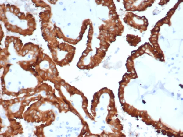 Formalin-fixed, paraffin-embedded human kidney cancer stained with Crystallin Alpha B Mouse Monoclonal Antibody (CRYAB/4665). HIER: Tris/EDTA, pH9.0, 45min. 2°C: HRP-polymer, 30min. DAB, 5min.