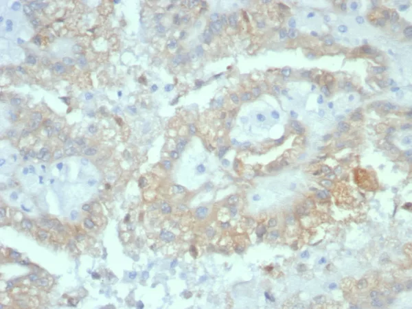 Formalin-fixed, paraffin-embedded human renal cell carcinoma stained with Crystallin Alpha B Mouse Monoclonal Antibody (CRYAB/7918). HIER: Tris/EDTA, pH9.0, 45min. 2°C: HRP-polymer, 30min. DAB, 5min.