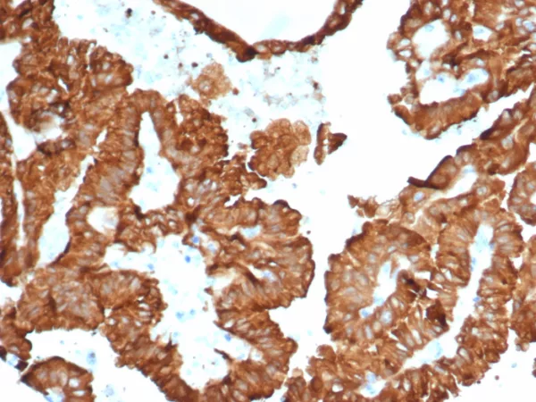 Formalin-fixed, paraffin-embedded human kidney cancer stained with Crystallin Alpha B Mouse Monoclonal Antibody (CRYAB/4657). HIER: Tris/EDTA, pH9.0, 45min. 2°C: HRP-polymer, 30min. DAB, 5min.