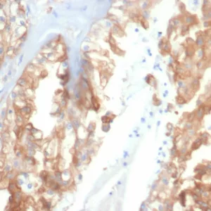 Formalin-fixed, paraffin-embedded human renal cell cancer stained with Crystallin Alpha B Mouse Monoclonal Antibody (CRYAB/4659). HIER: Tris/EDTA, pH9.0, 45min. 2°C: HRP-polymer, 30min. DAB, 5min.