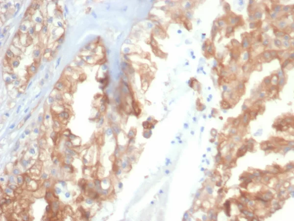 Formalin-fixed, paraffin-embedded human renal cell cancer stained with Crystallin Alpha B Mouse Monoclonal Antibody (CRYAB/4659). HIER: Tris/EDTA, pH9.0, 45min. 2°C: HRP-polymer, 30min. DAB, 5min.