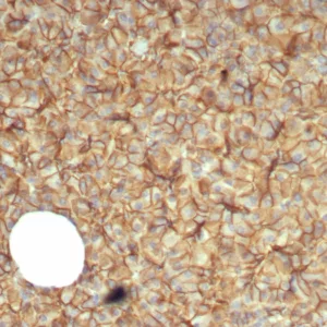 Formalin-fixed, paraffin-embedded human pancreas stained with Beta-Catenin Mouse Monoclonal Antibody (CTNNB1/7760). HIER: Tris/EDTA, pH9.0, 45min. 2°C: HRP-polymer, 30min. DAB, 5min.