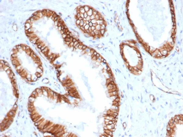 Formalin-fixed, paraffin-embedded human prostate carcinoma stained with  Beta-Catenin Recombinant Rabbit Monoclonal Antibody (CTNNB1/6807R). HIER: Tris/EDTA, pH9.0, 45min. 2°C: HRP-polymer, 30min. DAB, 5min.