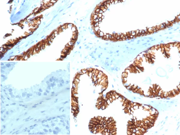 Formalin-fixed, paraffin-embedded human prostate carcinoma stained with  Beta-Catenin Recombinant Rabbit Monoclonal Antibody (CTNNB1/6807R). Inset: PBS instead of primary antibody; secondary only negative control