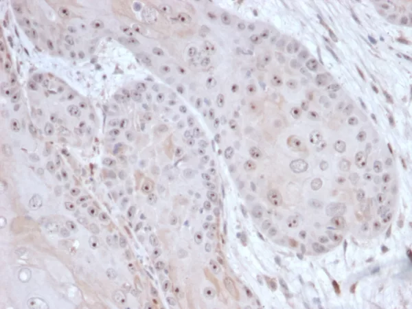 Formalin-fixed, paraffin-embedded human tumor of unknown origin stained with DAXX Mouse Monoclonal Antibody (PCRP-DAXX-6E11) at 2ug/ml. HIER: Tris/EDTA, pH9.0, 45min. 2°C: HRP-polymer, 30min. DAB, 5min.