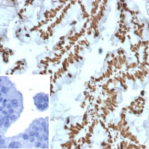 Formalin-fixed, paraffin-embedded human prostate carcinoma stained with ZNF690 / ZSCAN29 Mouse Monoclonal Antibody (PCRP-ZNF846-1E12). Inset: PBS instead of primary antibody; secondary only negative control.