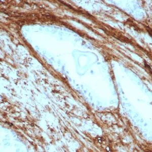 Formalin-fixed, paraffin-embedded human prostate carcinoma stained with Decorin Rabbit Recombinant Monoclonal Antibody (DCN/8715R). HIER: Tris/EDTA, pH9.0, 45min. 2°C: HRP-polymer, 30min. DAB, 5min.